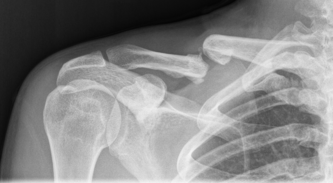 Clavicle Shaft Fractures Trauma Orthobullets